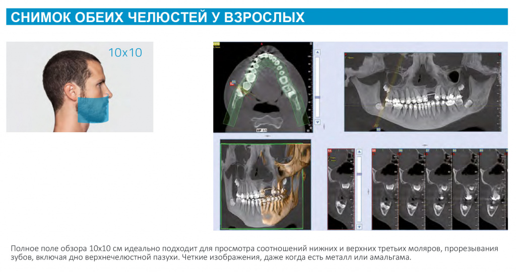 Примеры 3D-исследований полного зубного ряда на NewTom GO