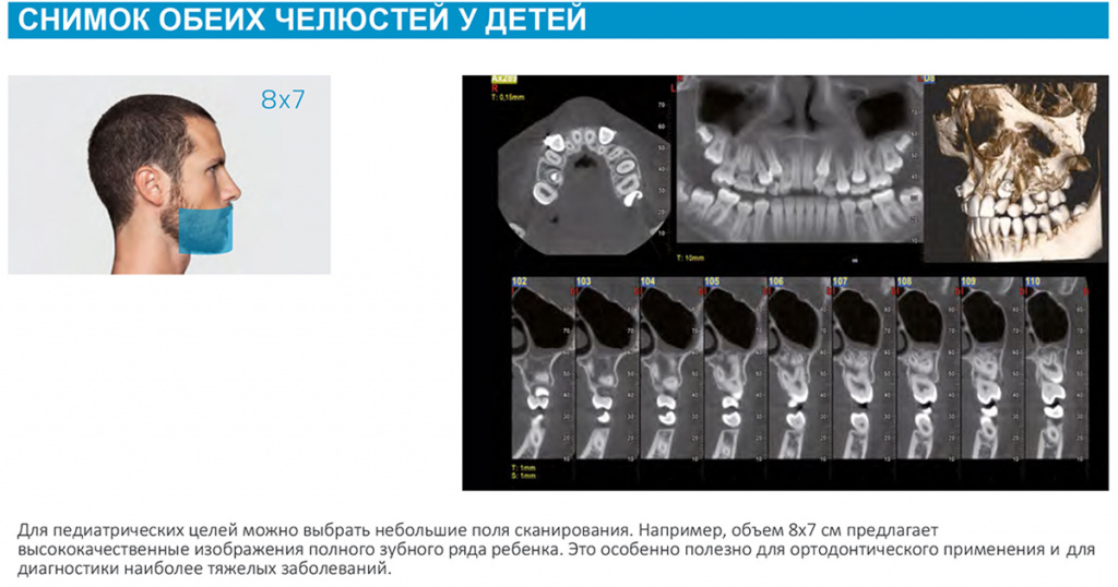 Пример 3D-исследования зубного ряда ребёнка