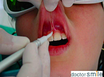 Диодный стоматологический лазер D5 Doctor Smile