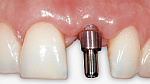 Порошкоструйный наконечник KaVo PROPHYflex-4, разъем Multiflex, розовый.