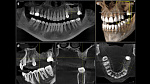 Dentsply Sirona Orthophos S 3D, FOV до 11 × 10 см, с цефалостатом