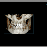 PointNix Point 3D Combi 500C, FOV 10 × 9 см, с цефалостатом