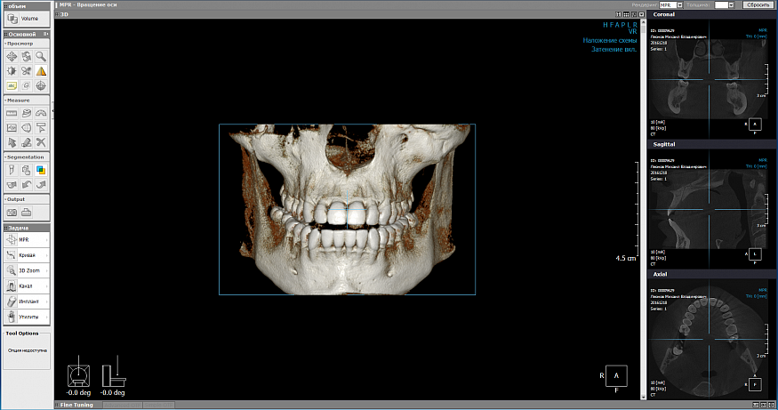 PointNix Point 3D Combi 500C, FOV 10 × 9 см, с цефалостатом