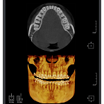 Дентальный 3D томограф с цефалостатом RAYSCAN Symphony a+ 160 SM3D (16х10)