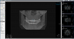 PointNix Point 3D Combi 500C, FOV 10 × 9 см, с цефалостатом