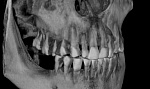 Дентальный цифровой томограф FONA XPan 3D (8,5x8,5)