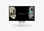 Дентальный томограф HDX 3D Dentri C-a (16х10)