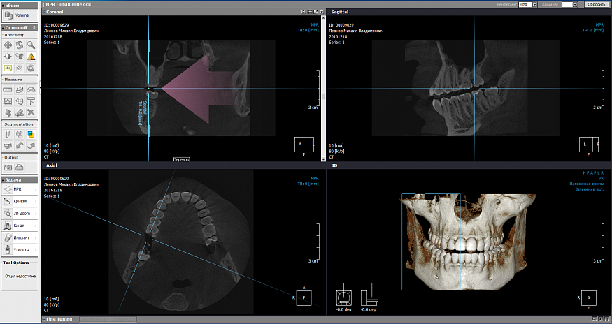 PointNix Point 3D Combi 500C, FOV 10 × 9 см, с цефалостатом