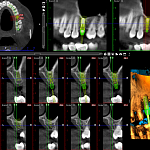 Дентальный томограф ProMax 3D Ceph с цефом (8*8)
