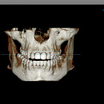 PointNix Point 3D Combi 500C, FOV 10 × 9 см, с цефалостатом