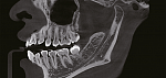 Дентальный 3D томограф EighTeeth FinScan F350 16x10 с ПК, 3 года гарантия