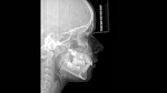 Dentsply Sirona Orthophos SL 3D, FOV до 11 × 10 см, с цефалостатом