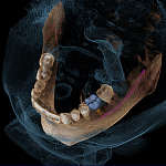 Дентальный томограф GALILEOS 150*150мм + FaceScanner