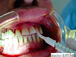 Диодный стоматологический лазер D5 Doctor Smile