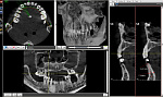 Дентальный цифровой томограф FONA XPan 3D (8,5x8,5)