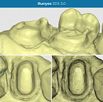 Интраоральный 3D сканер Runyes IOS-11 V3
