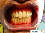 Диодный стоматологический лазер D5 Doctor Smile