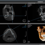 HDX WILL DENTRI-a 3D, FOV 18 × 16,5 см, без цефалостата
