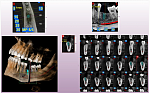 MyRay Hyperion X9 PRO, FOV 11 × 13 см, без цефалостата