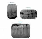 VistaScan Nano Easy - сканер фосфорных пластин Durr Dental