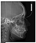 Дентальный 3D томограф Rayscan Symphony α+ с цефалостатом (13x10)