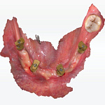 Shining 3D Aoralscan Elite - интраоральный сканер с фотограмметрией