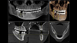 Dentsply Sirona Orthophos SL 3D, FOV до 11 × 10 см, с цефалостатом