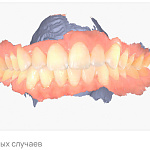 Aoralscan Elite интраоральный сканер