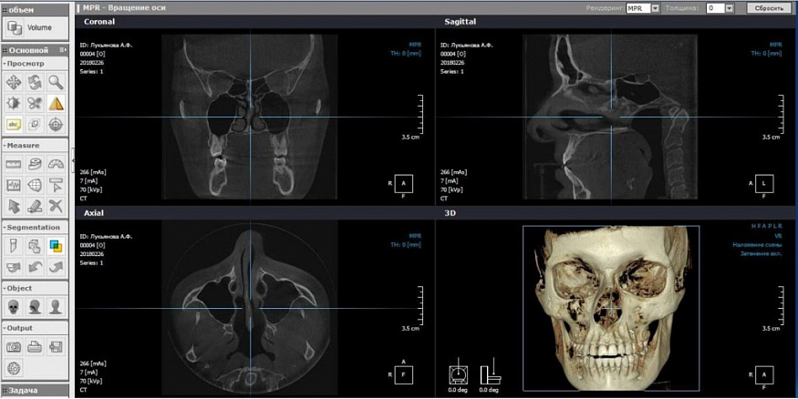 PointNix Point 3D Combi, FOV 16 × 15 см, без цефалостата
