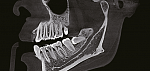 Дентальный 3D томограф EighTeeth FinScan F350 16x10 с ПК, 3 года гарантия