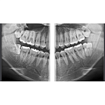 Дентальный 3D томограф с цефалостатом RAYSCAN Symphony a+ 160 SM3D (16х10)