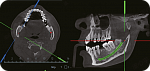 Дентальный 3D томограф EighTeeth FinScan F350 16x10 с ПК, 3 года гарантия