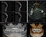 Дентальный 3D томограф Rayscan Symphony α-3D (9x9)