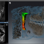 Dentsply Sirona Orthophos SL 3D, FOV до 11 × 10 см, с цефалостатом