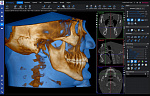 Planmeca ProMax 3D Mid с цефалостатом (20x17) 