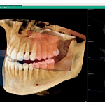 Vatech Smart Plus, анатомический FOV 12 × 9 см