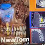 Дентальный 3D томограф NewTom Giano HR PROFESSIONAL с цефалостатом (16x18)