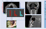 Дентальный 3d томограф NewTom с цефалостатом, бу 2019г (13x11), гарантия 1 год