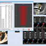 Дентальный 3D томограф NewTom Giano HR Prime с цефалостатом (11x8)