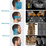 Дентальный 3D томограф NewTom Giano HR PROFESSIONAL с цефалостатом (16x18)